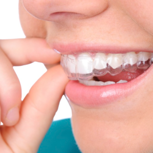 Tẩy Trắng Răng Bằng Máng