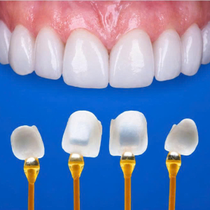 MẶT DÁN SỨ VENEER
