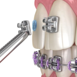 Niềng Răng Mắc Cài Là Gì?