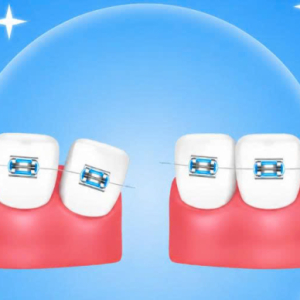 Niềng răng trẻ em