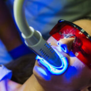 Tẩy trắng bằng đèn Plasma